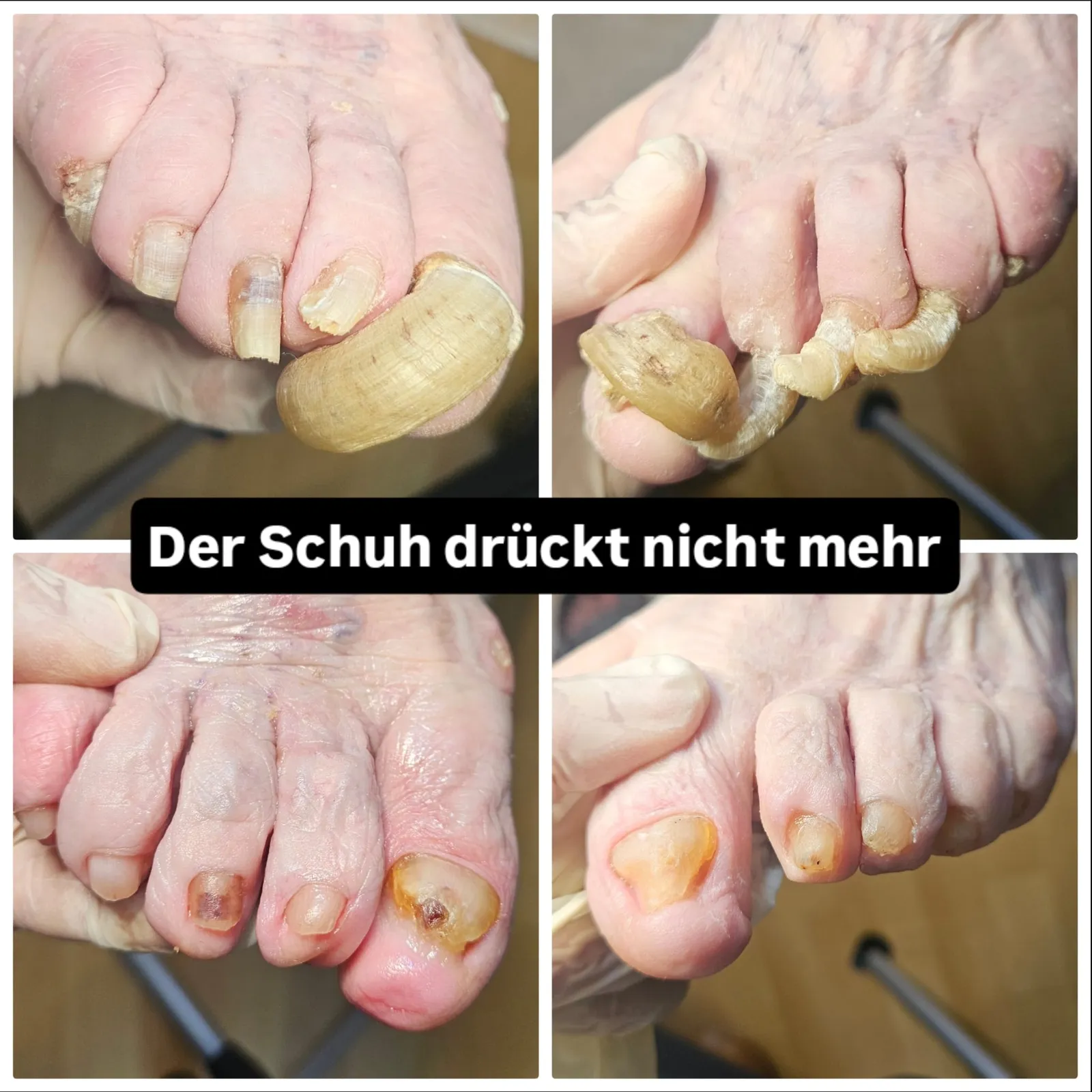 Extrem überwucherte Zehennägel vorher und nachher — Der Schuh drückt nicht mehr